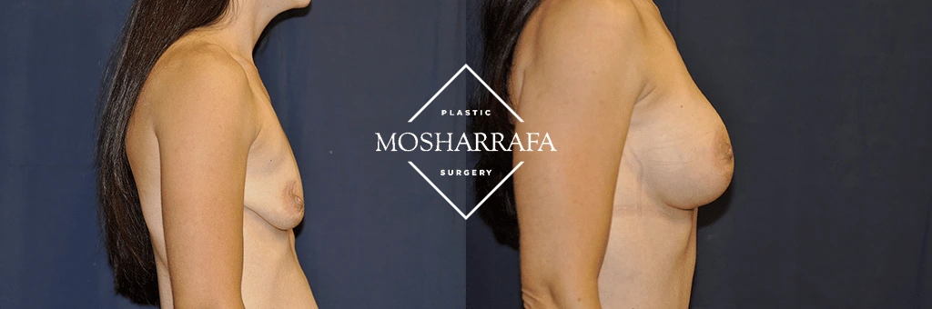 Before and after side profile comparison of breast augmentation results