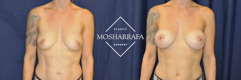 Before and after frontal view comparison of breast augmentation results
