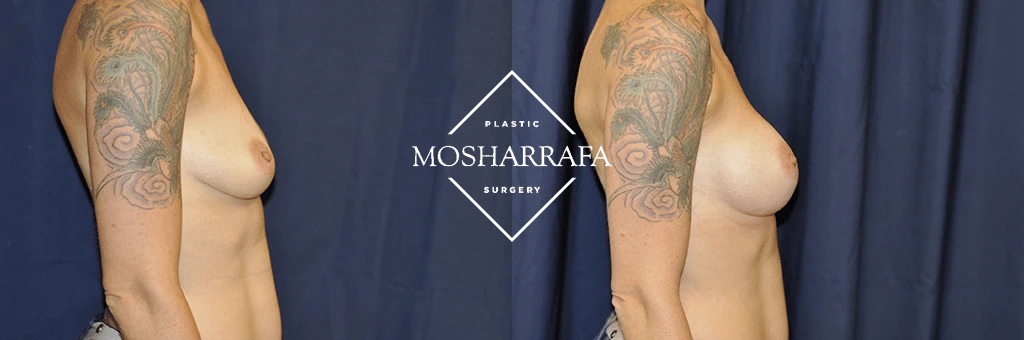 Before and after frontal view of breast augmentation results with tattooed arms