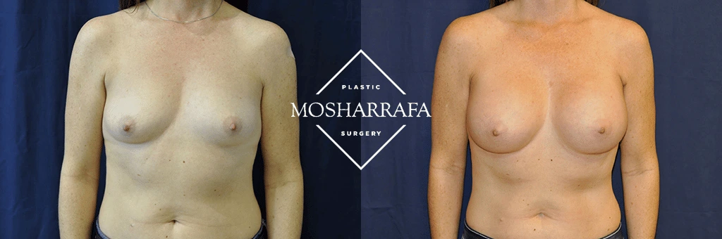 Before and after frontal view of breast augmentation results