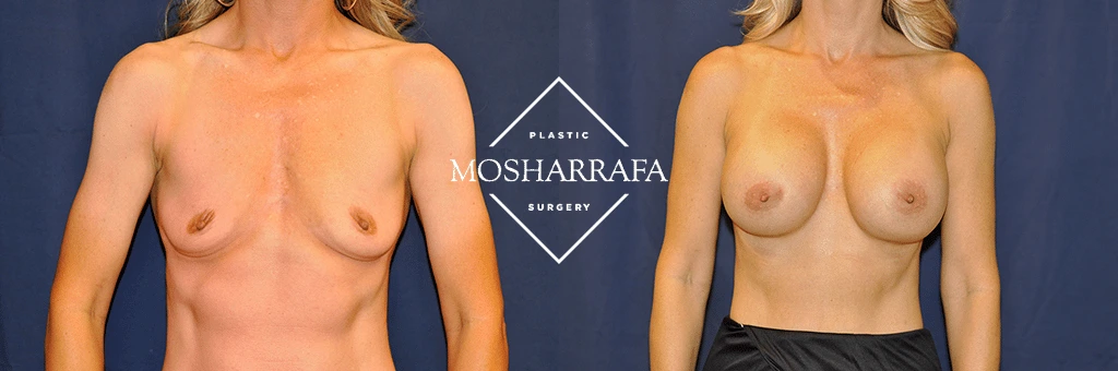 Before and after breast augmentation, front view comparison