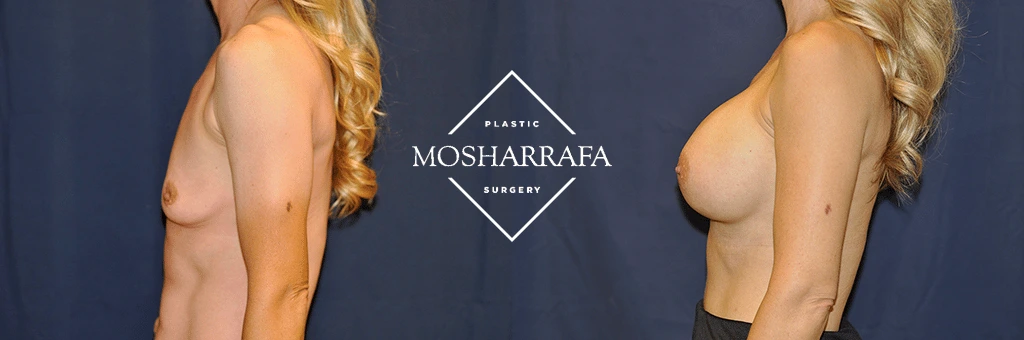Before and after breast augmentation, side profile comparison