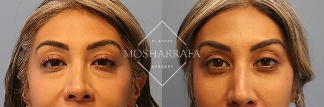 Before and after front-facing views showing orbital and facial changes