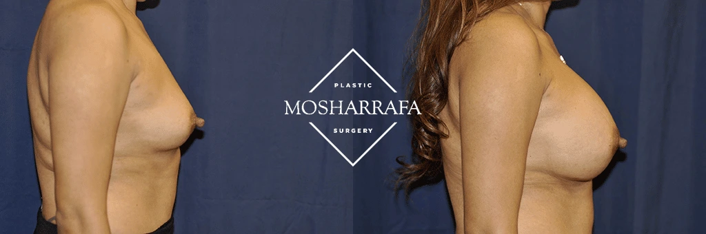 Before and after side profile views of breast augmentation results