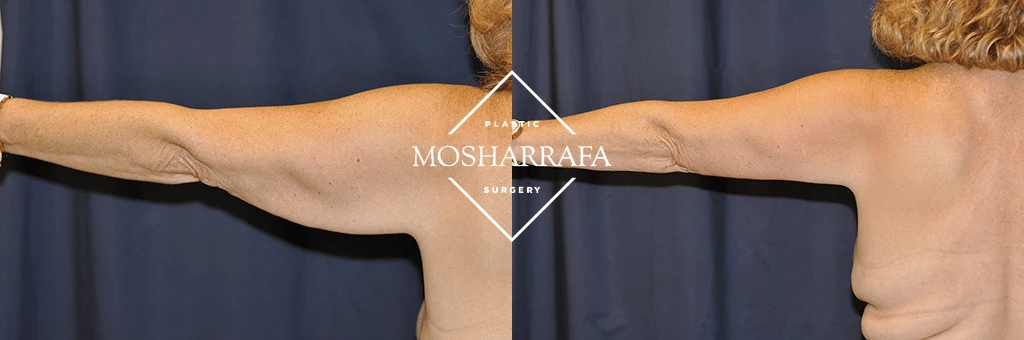 Patient's arms extended displaying enhanced skin texture and tightening results