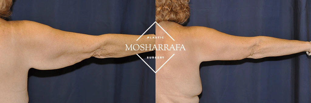 Patient's arms in extended position showing improved skin appearance and definition