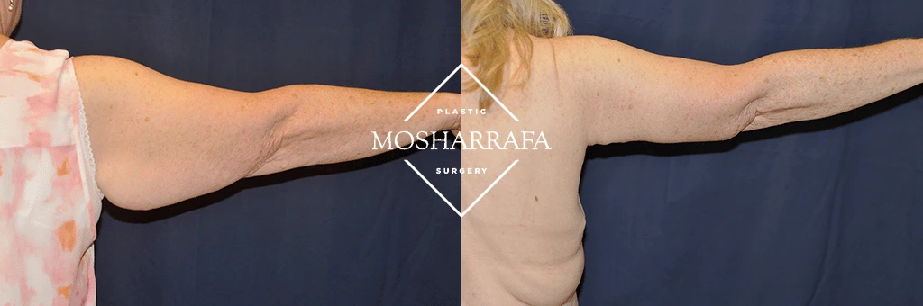 Patient's arms outstretched showing improved skin firmness and reduced sagging