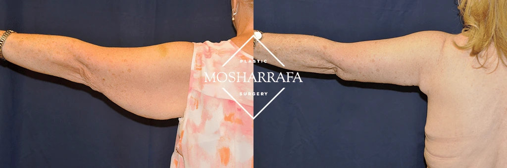 Before and after comparison of arm lift surgery results