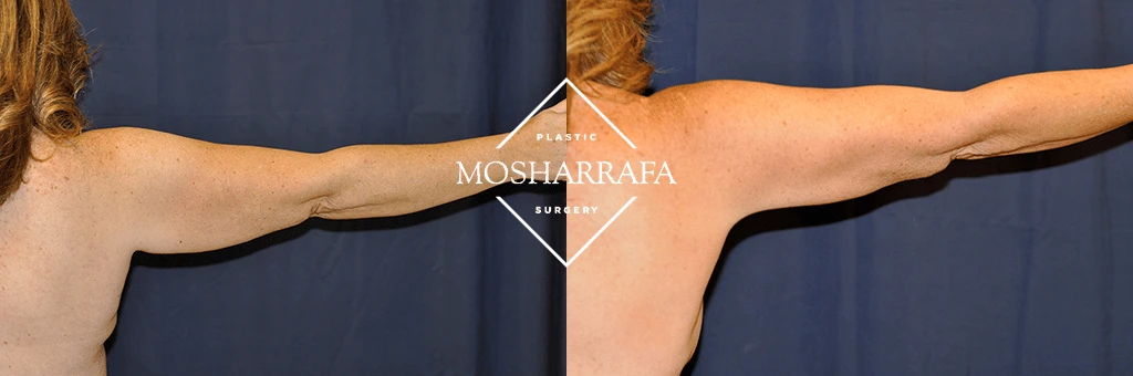 Before and after of patient's upper arms showing improved skin tone and definition after cosmetic procedure