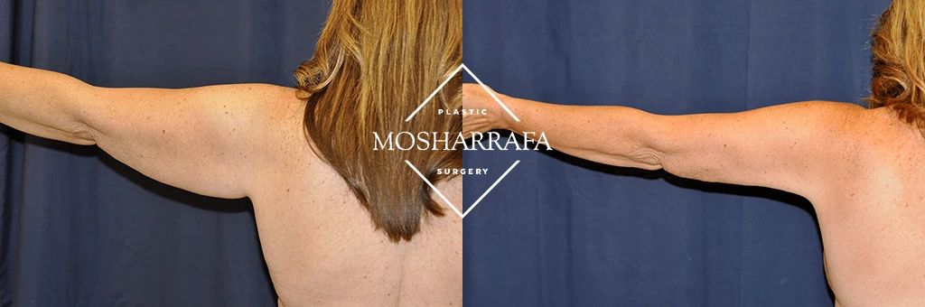 Before and after of patient's upper back and arms showing enhanced contour and skin appearance