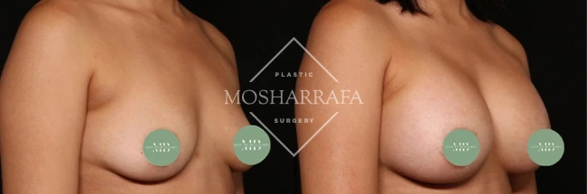 Before and after breast augmentation results, front view