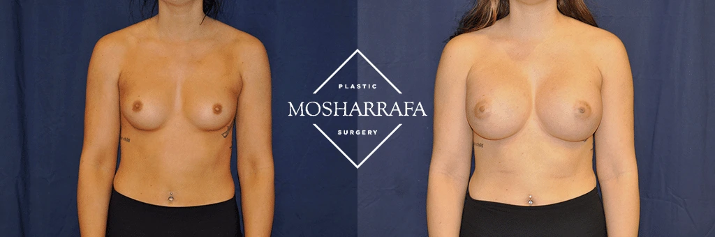 Before and after front view of breast augmentation results