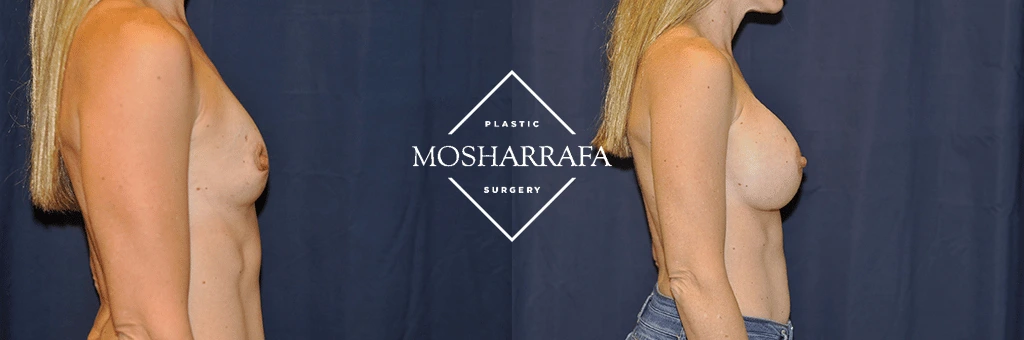 Before and after side profile comparison of breast augmentation results