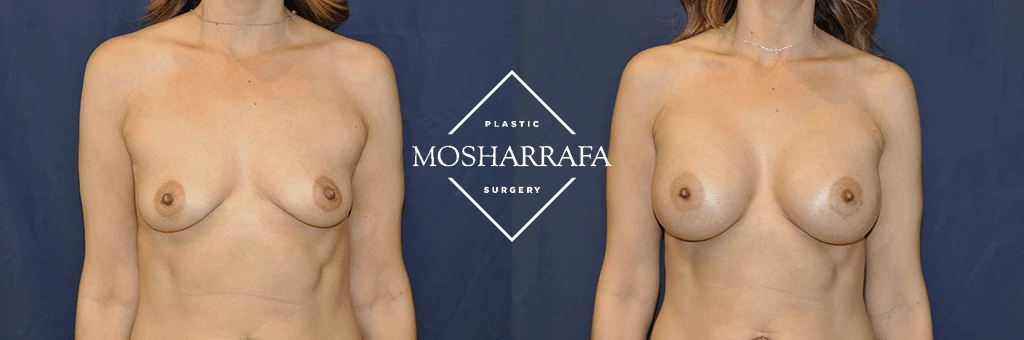 Before and after front view of breast augmentation results