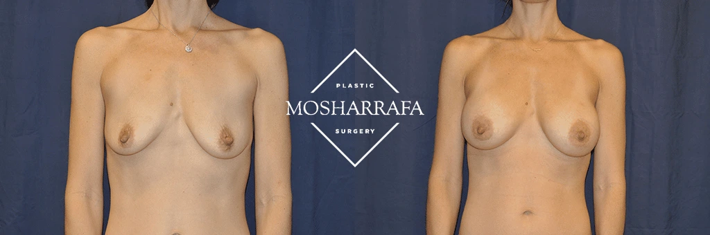 Before and after front view comparison of breast augmentation results