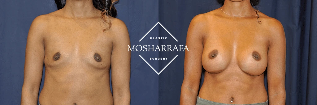 Before and after frontal view of breast augmentation results