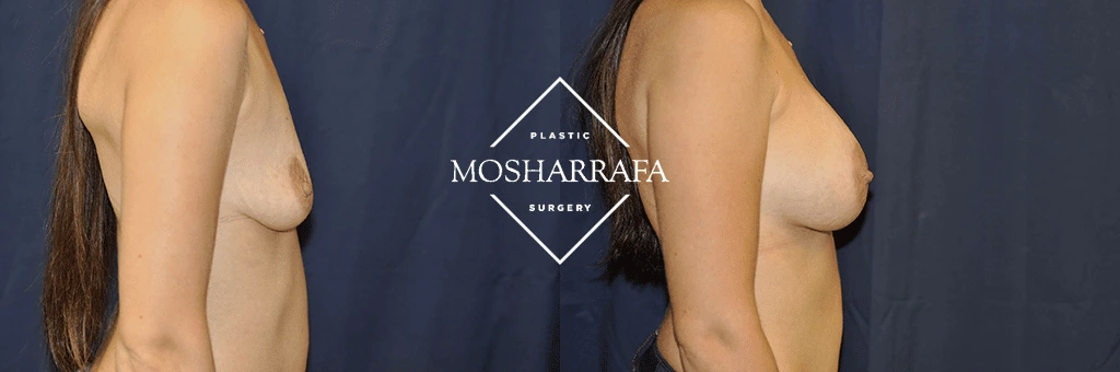 Breast augmentation before and after, side profile comparison