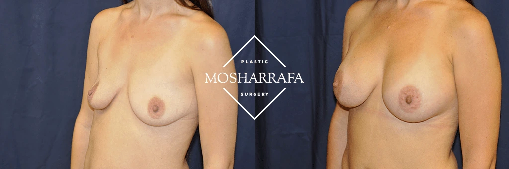 Breast augmentation before and after, three-quarter view comparison