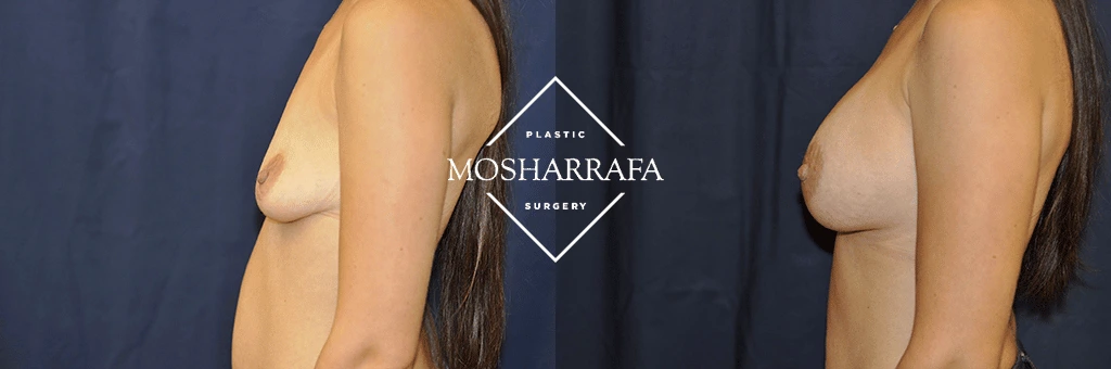 Breast augmentation before and after, side view with long dark hair