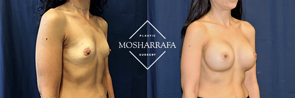 Before and after front view of breast augmentation surgery results