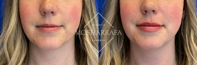 Before and after lip filler treatment, front view