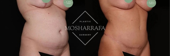 Before and after tummy tuck, oblique view showing reduced abdominal laxity