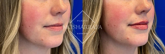 Before and after lip filler treatment, oblique right view