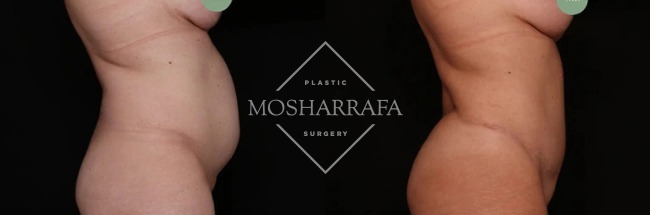 Before and after tummy tuck, side view showing improved waistline definition