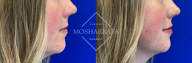 Before and after profile view of lip filler treatment showing fuller lips on the right