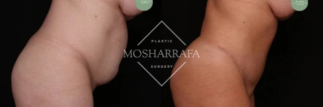 Before and after tummy tuck, side view showing enhanced abdominal profile