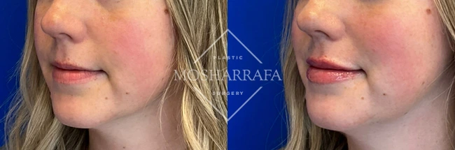 Before and after oblique view of lip filler treatment showing enhanced lip volume