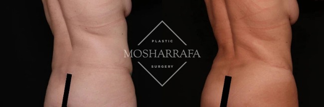 Before and after tummy tuck, oblique view showing overall body contour improvement
