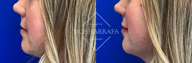 Before and after lateral profile view of lip filler treatment showing fuller lips on the right
