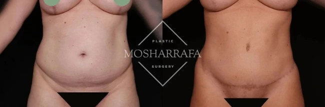 Before and after abdominal contouring results, frontal view
