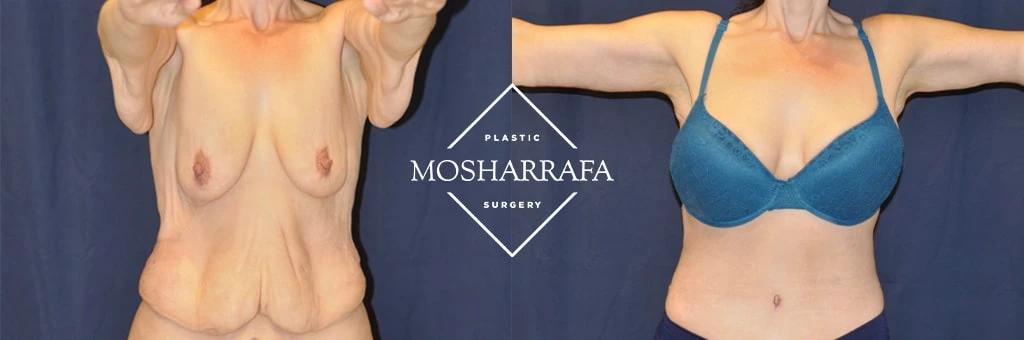 Before and after total body lift: left shows loose breast and torso skin, right shows lifted breasts and defined abdomen