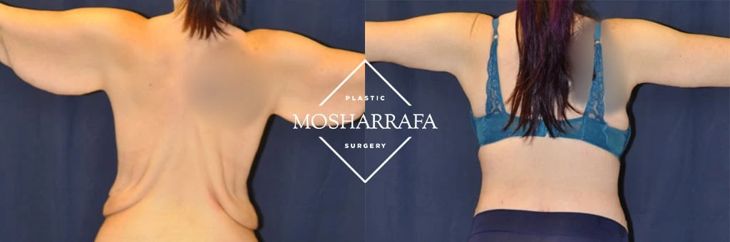 Before and after total-body-lift showing upper body and arms from behind and front