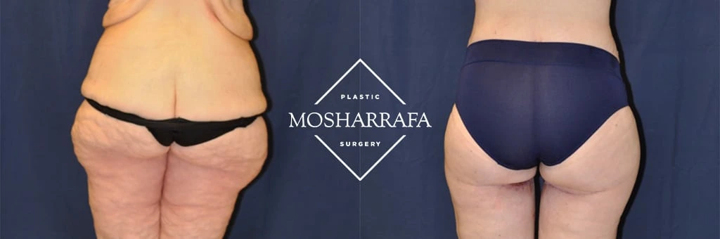Before and after total-body-lift showing lower body and buttocks from behind