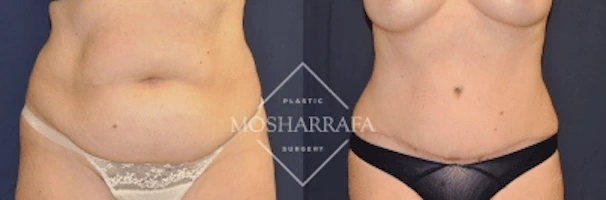 Before and after tummy tuck surgery, front view showing abdominal contouring results