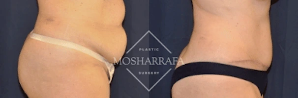 Before and after tummy tuck surgery, side view showing waist and abdominal definition