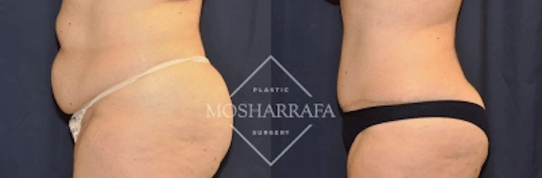 Before and after tummy tuck surgery, side view showing torso contour improvement