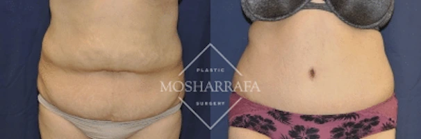 Tummy tuck before and after, frontal view showing flattened abdomen and repositioned navel