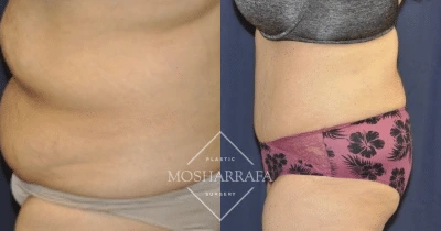 Tummy tuck before and after, side view showing improved abdominal profile and skin tightening