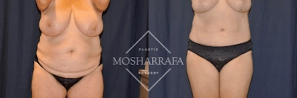 Before and after tummy tuck front view showing abdominal contouring results