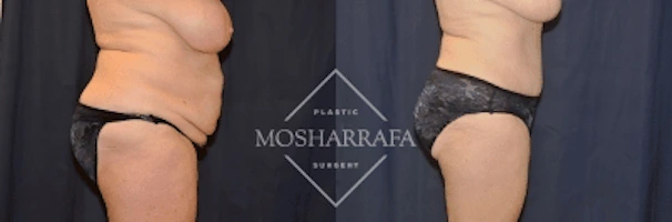 Before and after tummy tuck side view showing waist and torso definition