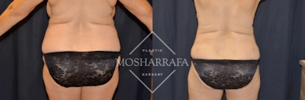 Before and after tummy tuck back view showing lower torso improvement