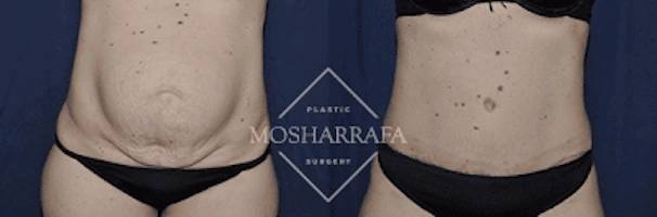 Before and after tummy tuck results showing frontal view with reduced abdominal laxity