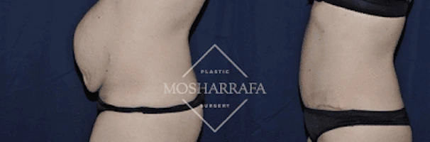 Before and after tummy tuck results showing right side profile with tightened abdominal skin