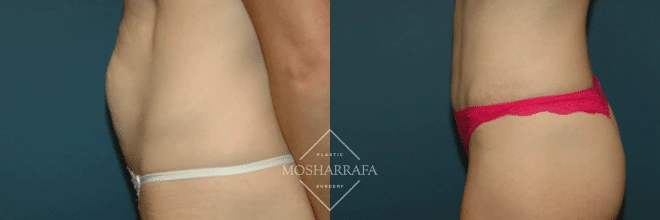 Before and after tummy tuck, side profile showing improved abdominal contour