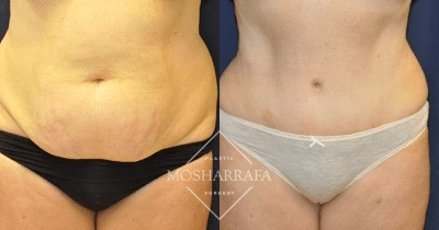 Before and after tummy tuck with frontal view of midsection