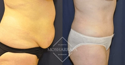 Before and after tummy tuck showing side-by-side abdominal comparison